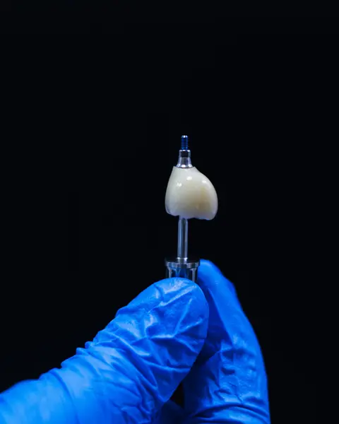 A single implant crown on its post, held up in a blue glove against a dark background.
