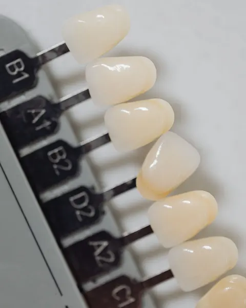 A dental shade guide fanned out, each tab a slightly different tooth colour.